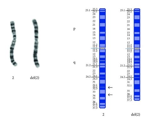 G Banded Karyotype And Corresponding Ideogram Of Chromosomes 2 Panels Download Scientific