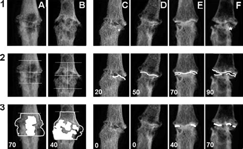 Morbid Anatomy Of Erosive Osteoarthritis Of The Interphalangeal