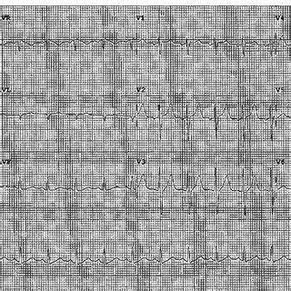 Ekg Showed Sinus Tachycardia With No St Or T Wave Changes Suggestive Of