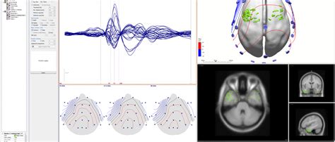 Curry Neuro Imaging Suite For Epilepsy Evaluation Compumedics Neuroscan