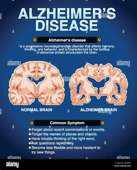 Informative Poster Of Alzheimers Disease Illustration Stock Vector