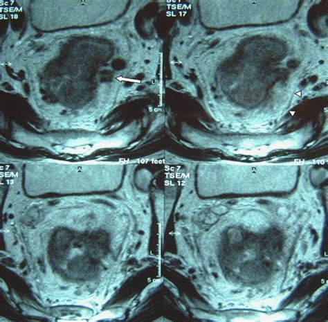 Accuracy Of Thin Section Magnetic Resonance Using Phased Array Pelvic Coil In Predicting The T