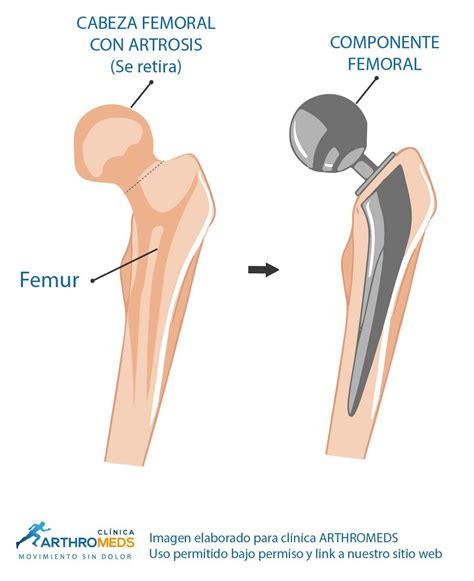 Cirug A Protesis Cadera Artrosis De Cadera Lima Per