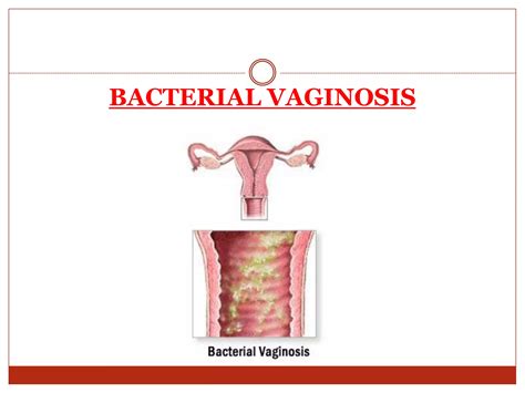 Infections During Pregnancy Ppt