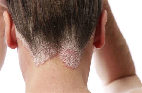 Dermatitis Seborreica Síntomas Diagnóstico y Tratamiento HiBooX