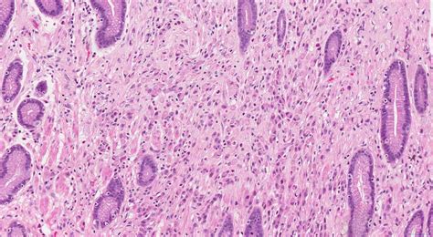 Adenocarcinoma of the stomach | Atlas of Pathology