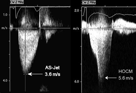 An Example Of Moderate Aortic Stenosis Left And Dynamic Outflow