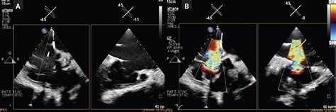 Three Dimensional Intracardiac Echocardiography Use In Tricuspid Valve