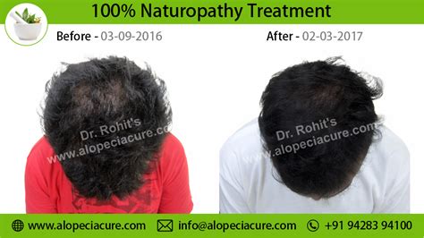 Alopecia Hair Loss Treatment Singapore