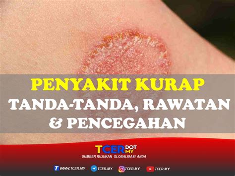 Jenis Kurap Dan Rawatan Sihat Cantik And Bahagia Atasi Penyakit Kulit