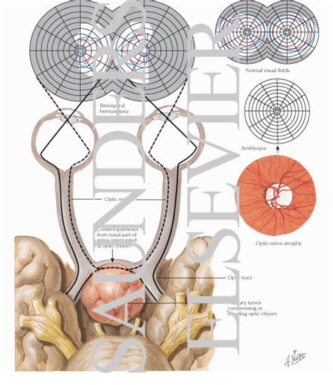 Pituitary Tumor: Visual Field Defect With Pituitary Tumor