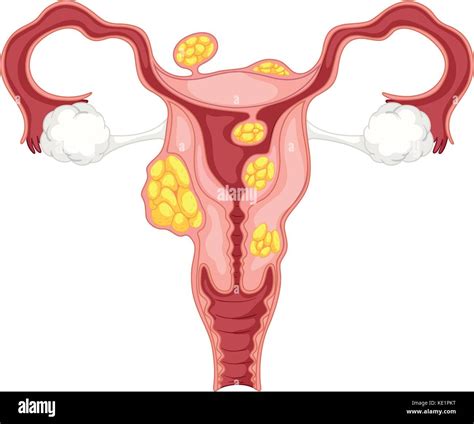 Diagram Of Subserosal Uterine Fibroids Illustration Stock Vector Image