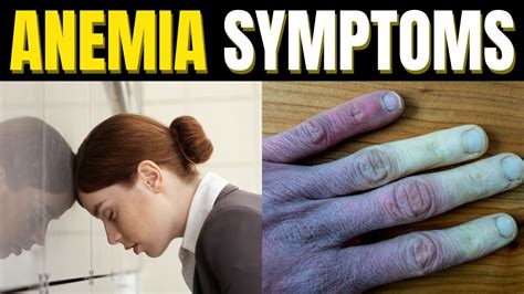 10 Anemia Symptoms You Shouldn T Ignore Hemoglobin Deficiency