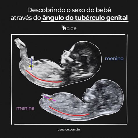 Como Descobrir O Sexo Do Beb Atrav S Do Tub Rculo Genital