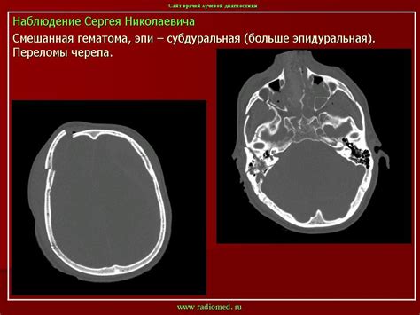 ГМ. Гематомы. Гематома. + | Портал радиологов