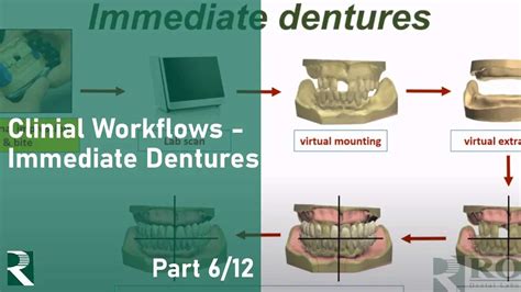 The Pathway To Digital Dentures Clinical Workflow Immediate Dentures