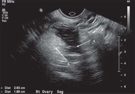 Squamous Cell Carcinoma Arising In A Dermoid Cyst Of The Ovary A Case Series