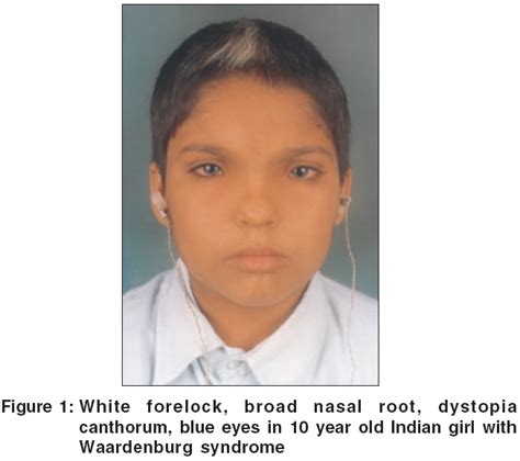 Waardenburg syndrome - Indian Journal of Dermatology, Venereology and Leprology