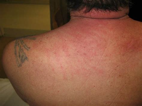 Dermatomyositis Skin Rash