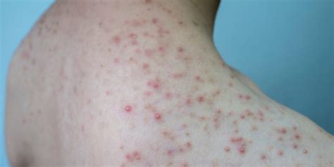 Bacterial Folliculitis On Face