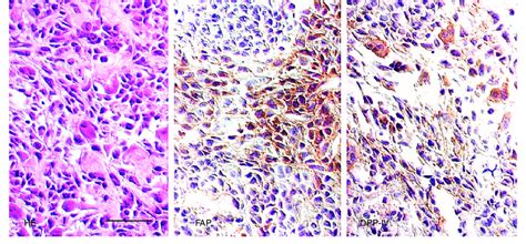 Immunohistochemistry Of A Fibroblastic Area Of An Osteosarcoma