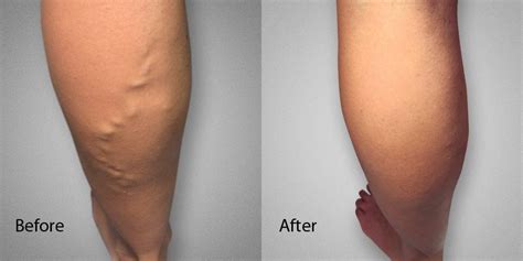 Before After Photos L Advanced Varicose Vein Treatments Of Manhattan NYC