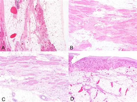 ARVC Fibrofatty Change A Section Of Left Ventricle Showing Areas Of