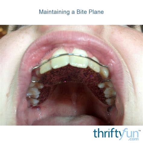 Maintaining a Bite Plane | ThriftyFun