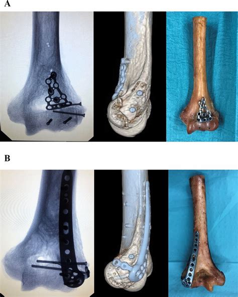 Illustration Of Fracture Fixation Of Simple Coronal Shear Fractures Of