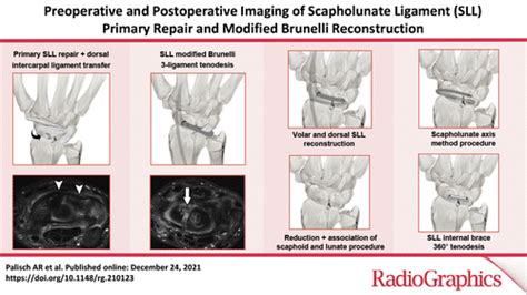 Preoperative And Postoperative Imaging Of Scapholunate Ligament Primary