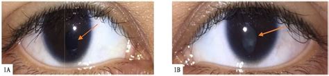 Pre Operative View Showed Microcornea And Iris Coloboma Orange Arrow