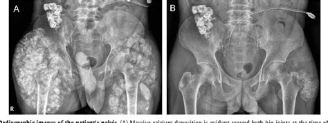 Figure 1 From Resolution Of Uremic Tumoral Calcinosis In A Patient On