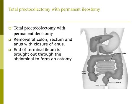 Ppt Bowel Diversion Ostomies Powerpoint Presentation Id998577