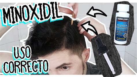 Como Aplicar Minoxidil En Cuero Cabelludo Paso A Paso Youtube