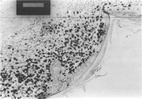 Biopsy Specimen From Skin Lesion Showing Hyperkeratosis And