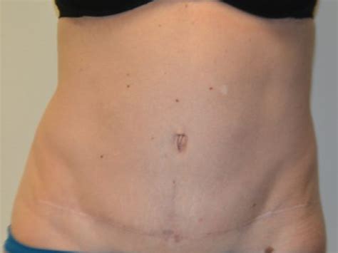 Tummy Tuck 29 Before After Gallery Allen Doezie MD FACS