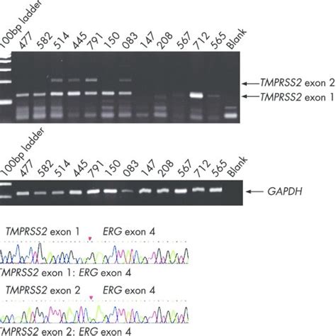 A Reverse Transcriptase Rt Pcr Analysis Of The Tmprss Erg Fusion