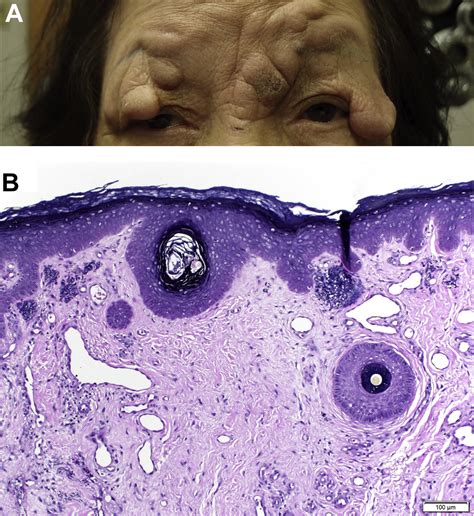 Acquired Cutis Laxa Presenting As Pedunculated Eyelid Plaques In An