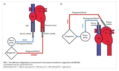 Clinical Use Of Venoarterial Extracorporeal Membrane Oxygenation Hkmj