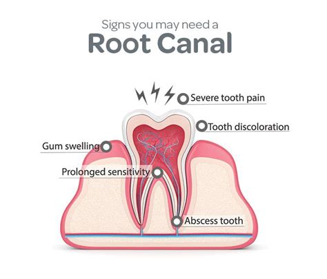 Painless Root Canal Treatment Therapy In Faridabad And Delhi Artofit