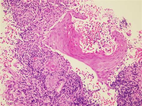 Popliteal Lymph Node Dissection For Metastatic Squamous Cell Carcinoma A Case Report Of An