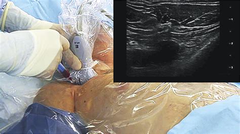 Ultrasound Guided Cannulation Of The Subclavian Vein NEJM