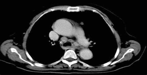 Multiple Pathological Lymph Node Enlargements With Calcification And Download Scientific