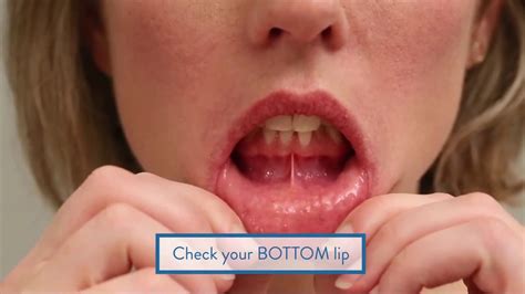 Teach Your Patients How To Check For Oral Cancer Youtube