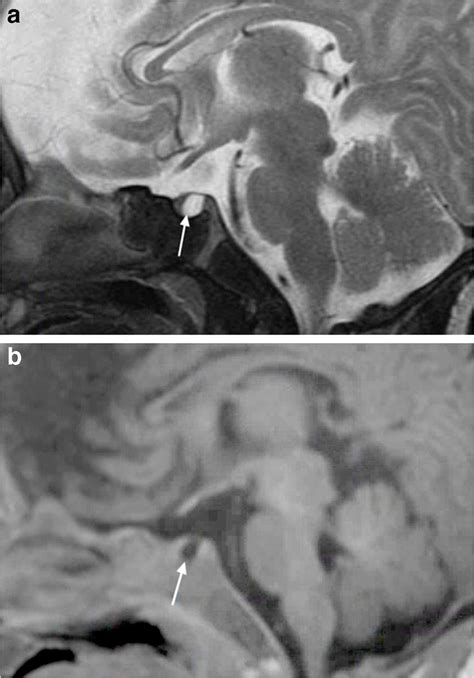 An 87 Day Old Boy With Incidental Pituitary Cyst On Routine Mri A