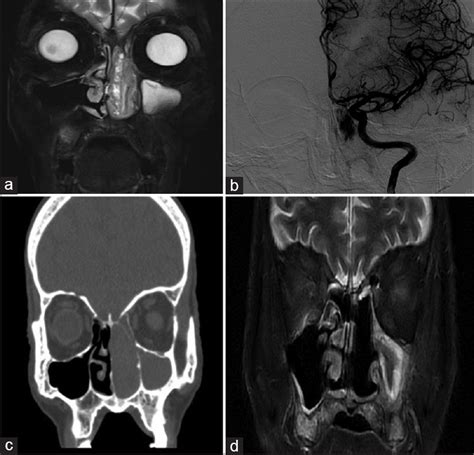 Pre And Post Operative Images Of A Left Nasal Ewings Sarcoma A