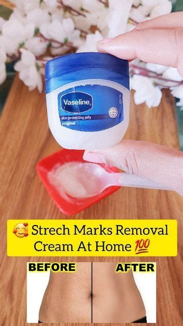 29 Effective Home Remedies To Reduce Stretch Marks Artofit