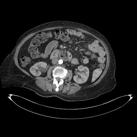 Duodenal Diverticulum Image