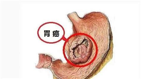 胃癌有蔓延、转移的可能！提醒：若有4种表现，小心胃癌“前兆”食物胃肠感觉