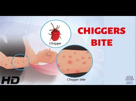 Chiggers Vs Ticks